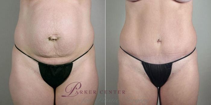 Mommy Makeover Case 1183 Before & After View  | Paramus, NJ | Parker Center for Plastic Surgery