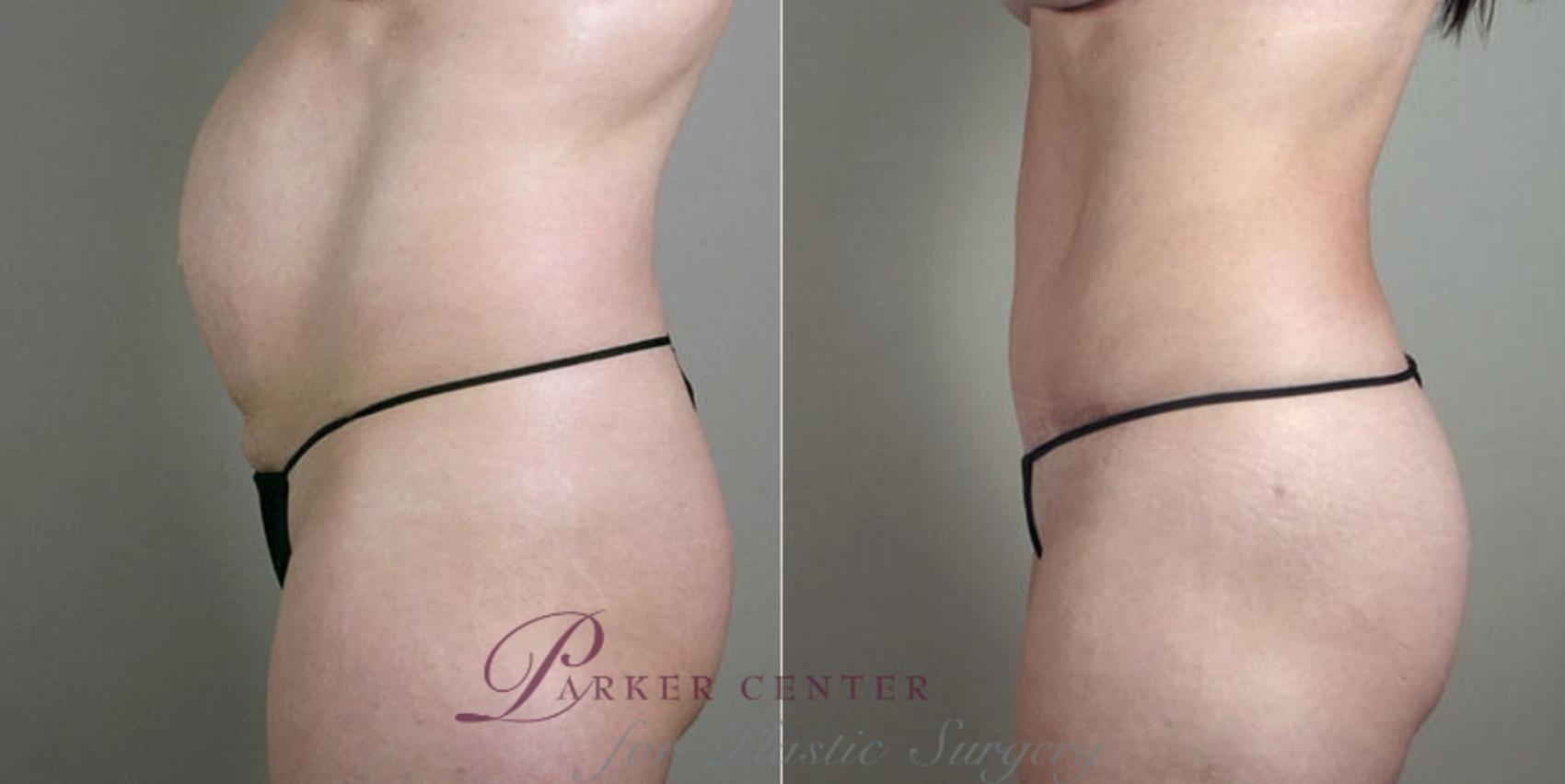 Mommy Makeover Case 1183 Before & After View 2 | Paramus, New Jersey | Parker Center for Plastic Surgery