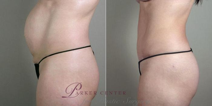 Mommy Makeover Case 1183 Before & After View 2 | Paramus, NJ | Parker Center for Plastic Surgery