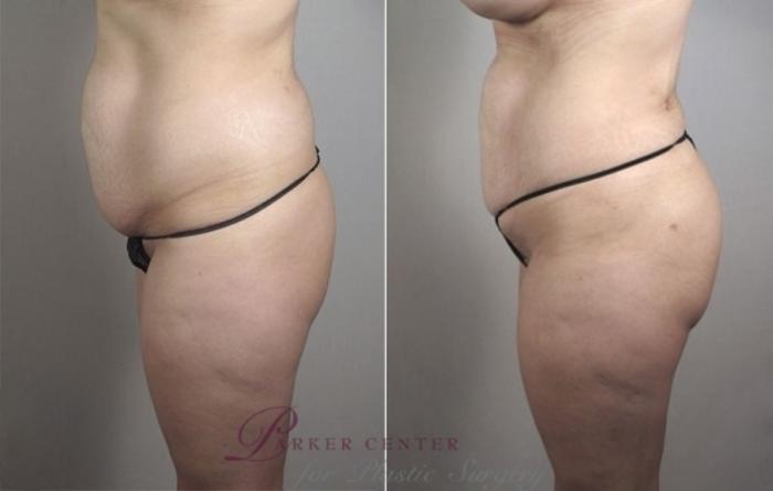 Liposuction Case 1184 Before & After View 1 | Paramus, NJ | Parker Center for Plastic Surgery
