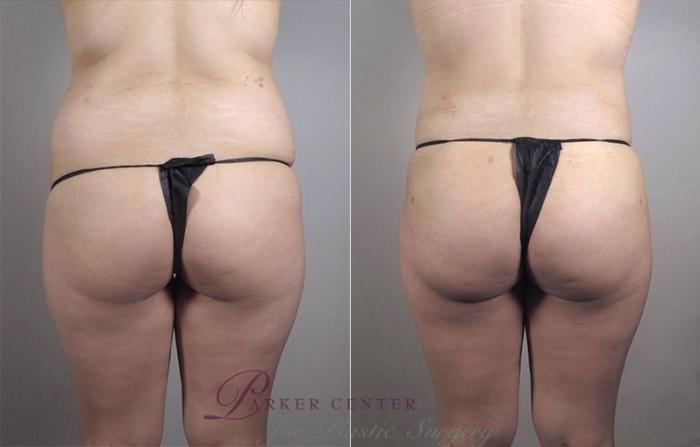 Liposuction Case 1184 Before & After View 3 | Paramus, NJ | Parker Center for Plastic Surgery