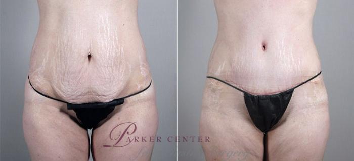 Mommy Makeover Case 1185 Before & After View 1 | Paramus, NJ | Parker Center for Plastic Surgery