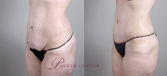 Mommy Makeover Case 1185 Before & After View 2 | Paramus, NJ | Parker Center for Plastic Surgery