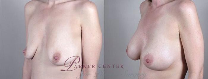 Mommy Makeover Case 1185 Before & After View 4 | Paramus, NJ | Parker Center for Plastic Surgery