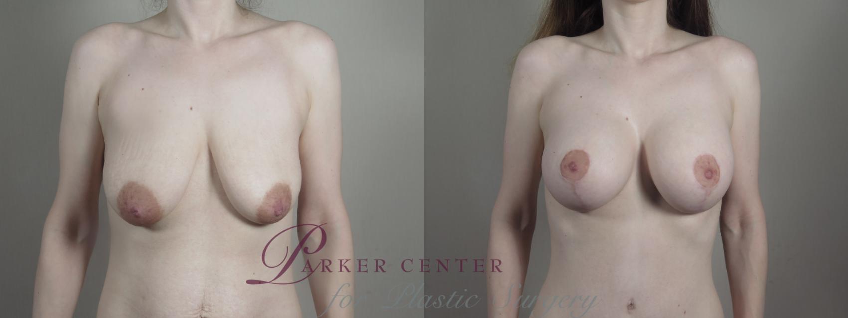 Breast Lift with Implants Case 1225 Before & After View #1  | Paramus, NJ | Parker Center for Plastic Surgery