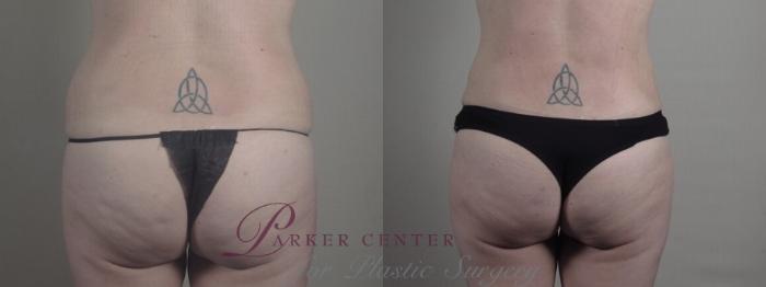 Liposuction Case 1240 Before & After Back | Paramus, NJ | Parker Center for Plastic Surgery