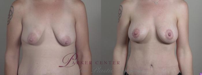 Breast Lift with Auto Aug Case 1240 Before & After Front | Paramus, NJ | Parker Center for Plastic Surgery