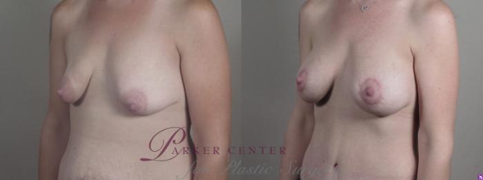 Breast Lift with Auto Aug Case 1240 Before & After Left Oblique | Paramus, NJ | Parker Center for Plastic Surgery