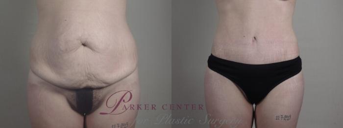 Liposuction Case 1240 Before & After Lower Front  | Paramus, NJ | Parker Center for Plastic Surgery