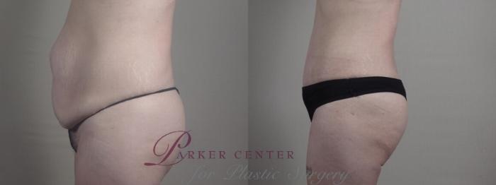 Liposuction Case 1240 Before & After Side | Paramus, NJ | Parker Center for Plastic Surgery