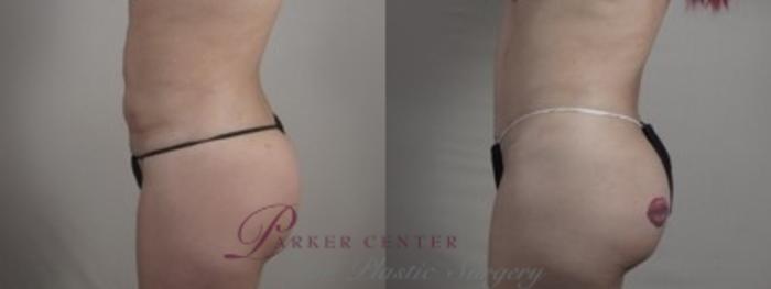 Liposuction Case 1241 Before & After Left Side | Paramus, NJ | Parker Center for Plastic Surgery