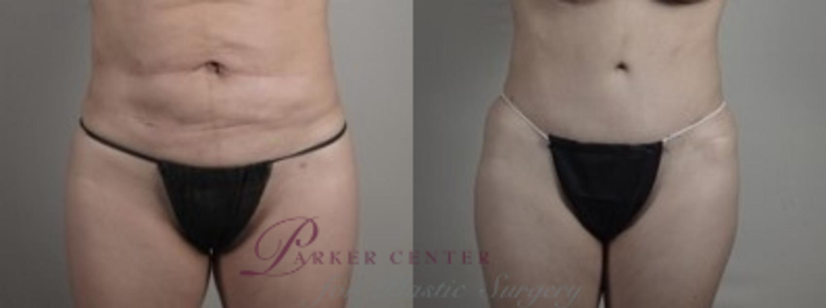 Body Case 1241 Before & After Lower Front  | Paramus, NJ | Parker Center for Plastic Surgery