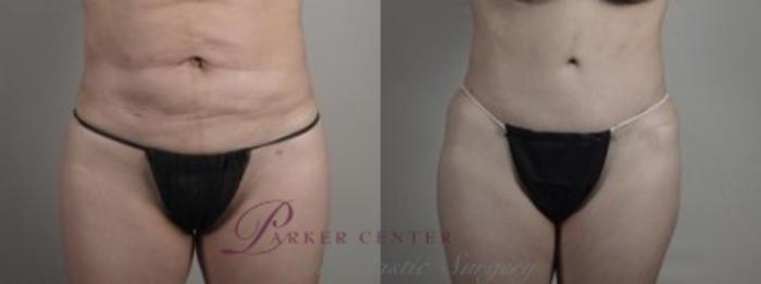 Liposuction Case 1241 Before & After Lower Front  | Paramus, NJ | Parker Center for Plastic Surgery