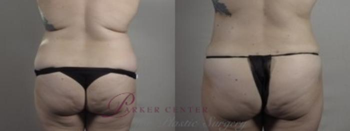 Mommy Makeover Case 1242 Before & After Back | Paramus, NJ | Parker Center for Plastic Surgery