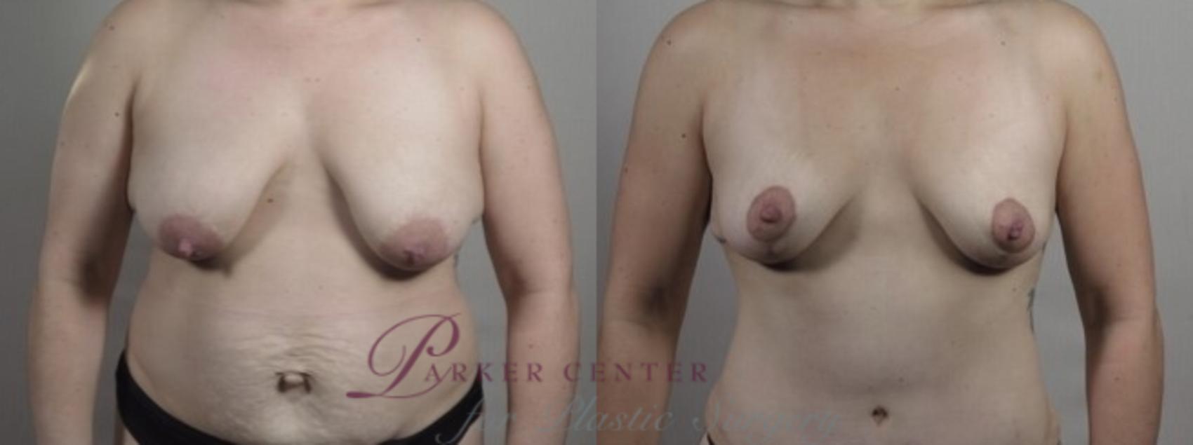 Breast Lift Case 1242 Before & After Front | Paramus, NJ | Parker Center for Plastic Surgery