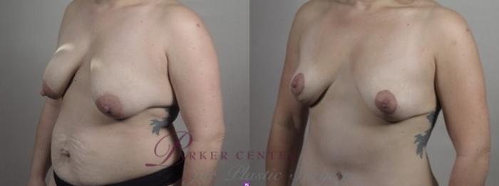Breast Lift Case 1242 Before & After Left Oblique | Paramus, NJ | Parker Center for Plastic Surgery