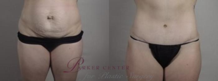 Body Case 1242 Before & After Lower Front  | Paramus, NJ | Parker Center for Plastic Surgery