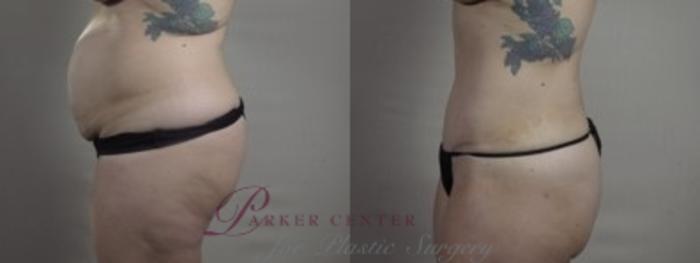 Body Case 1242 Before & After Side | Paramus, NJ | Parker Center for Plastic Surgery