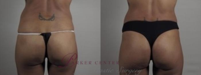 Liposuction Case 1243 Before & After Back | Paramus, NJ | Parker Center for Plastic Surgery