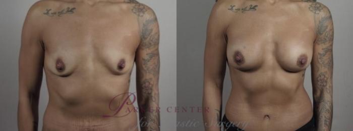 Breast Augmentation Case 1243 Before & After Front | Paramus, NJ | Parker Center for Plastic Surgery