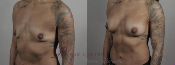Breast Augmentation Case 1243 Before & After Left Oblique | Paramus, NJ | Parker Center for Plastic Surgery