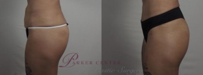 Liposuction Case 1243 Before & After Left Side | Paramus, NJ | Parker Center for Plastic Surgery