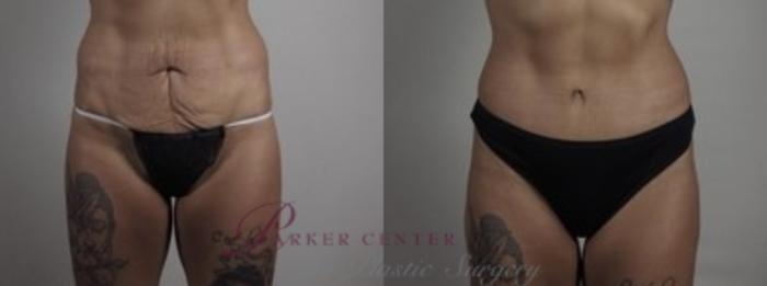 Body Case 1243 Before & After Lower Front  | Paramus, NJ | Parker Center for Plastic Surgery