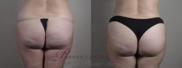 Mommy Makeover Case 1250 Before & After Back | Paramus, NJ | Parker Center for Plastic Surgery