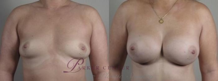 Breast Augmentation Case 1250 Before & After Front | Paramus, NJ | Parker Center for Plastic Surgery