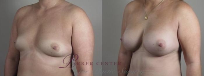 Breast Augmentation Case 1250 Before & After Left Oblique | Paramus, NJ | Parker Center for Plastic Surgery