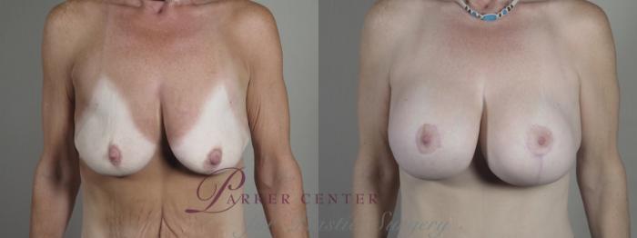 Mommy Makeover Case 1293 Before & After front | Paramus, NJ | Parker Center for Plastic Surgery