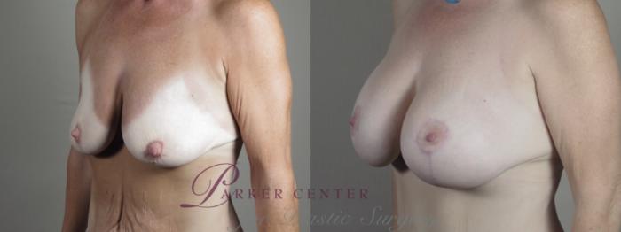 Mommy Makeover Case 1293 Before & After Left Oblique | Paramus, NJ | Parker Center for Plastic Surgery