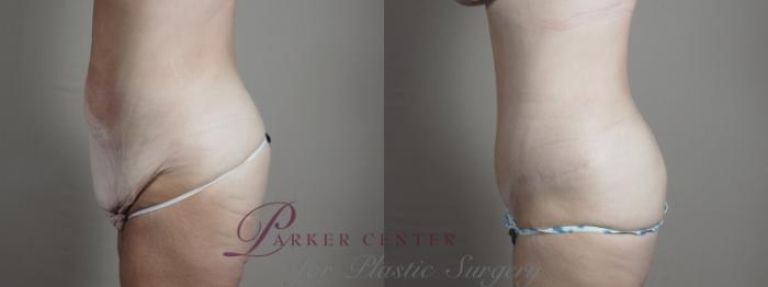Liposuction Case 1293 Before & After Left Side | Paramus, NJ | Parker Center for Plastic Surgery