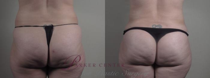 Liposuction Case 1294 Before & After Back | Paramus, NJ | Parker Center for Plastic Surgery