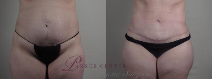 Mommy Makeover Case 1294 Before & After front  | Paramus, NJ | Parker Center for Plastic Surgery