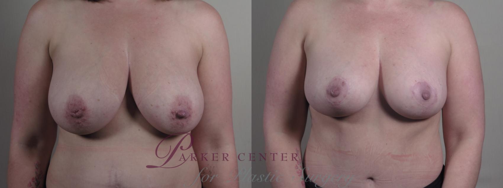 Tummy Tuck Case 1294 Before & After Front | Paramus, NJ | Parker Center for Plastic Surgery