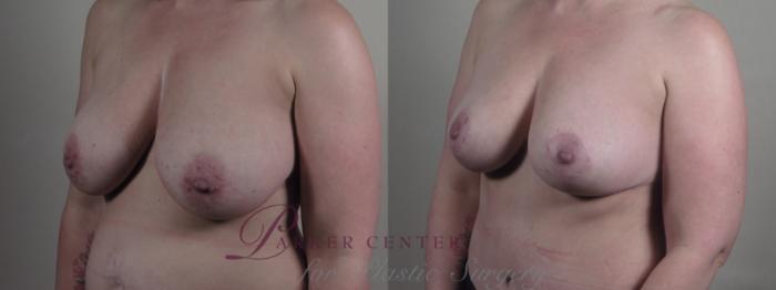 Mommy Makeover Case 1294 Before & After Left Oblique | Paramus, NJ | Parker Center for Plastic Surgery