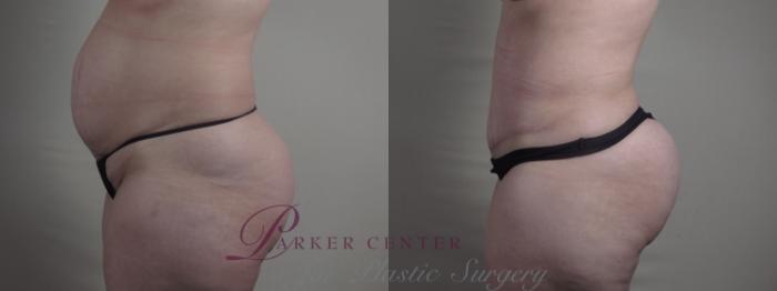 Liposuction Case 1294 Before & After Left Side | Paramus, NJ | Parker Center for Plastic Surgery