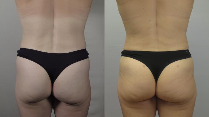 Mommy Makeover Case 1554 Before & After Back | Paramus, New Jersey | Parker Center for Plastic Surgery