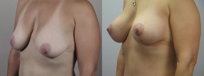 Mommy Makeover Case 1554 Before & After Left Oblique | Paramus, New Jersey | Parker Center for Plastic Surgery