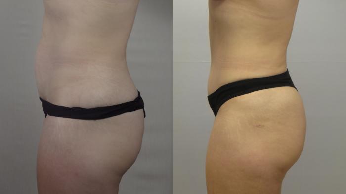 Mommy Makeover Case 1554 Before & After Left Side | Paramus, New Jersey | Parker Center for Plastic Surgery