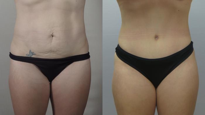 Mommy Makeover Case 1554 Before & After tt front view | Paramus, New Jersey | Parker Center for Plastic Surgery