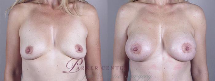 Mommy Makeover Case 376 Before & After View #1 | Paramus, NJ | Parker Center for Plastic Surgery