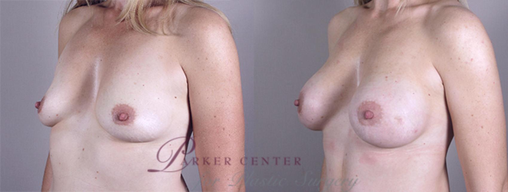 Mommy Makeover Case 376 Before & After View #2 | Paramus, NJ | Parker Center for Plastic Surgery