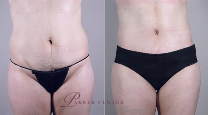 Mommy Makeover Case 376 Before & After View #3 | Paramus, NJ | Parker Center for Plastic Surgery
