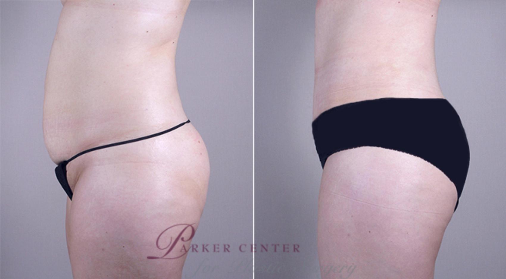 Mommy Makeover Case 376 Before & After View #4 | Paramus, NJ | Parker Center for Plastic Surgery