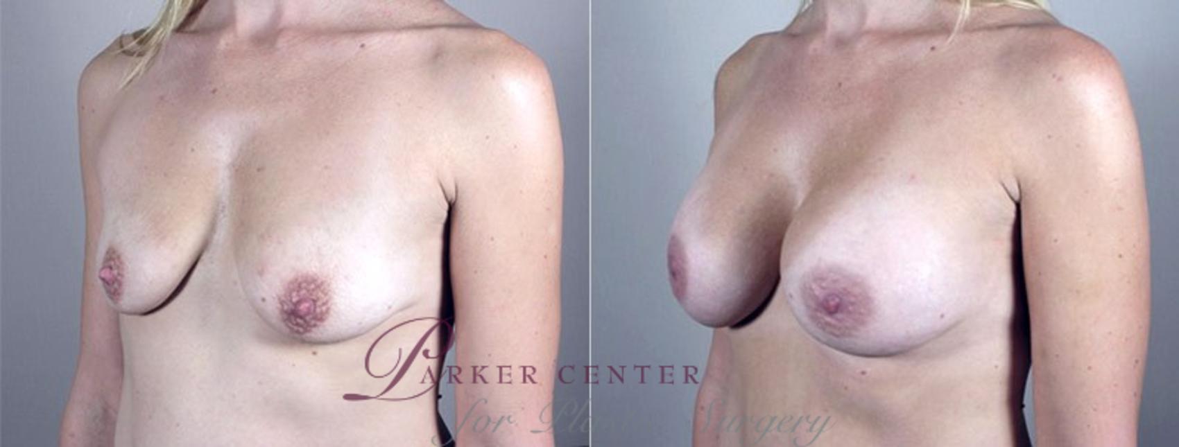 Mommy Makeover Case 381 Before & After View #2 | Paramus, NJ | Parker Center for Plastic Surgery