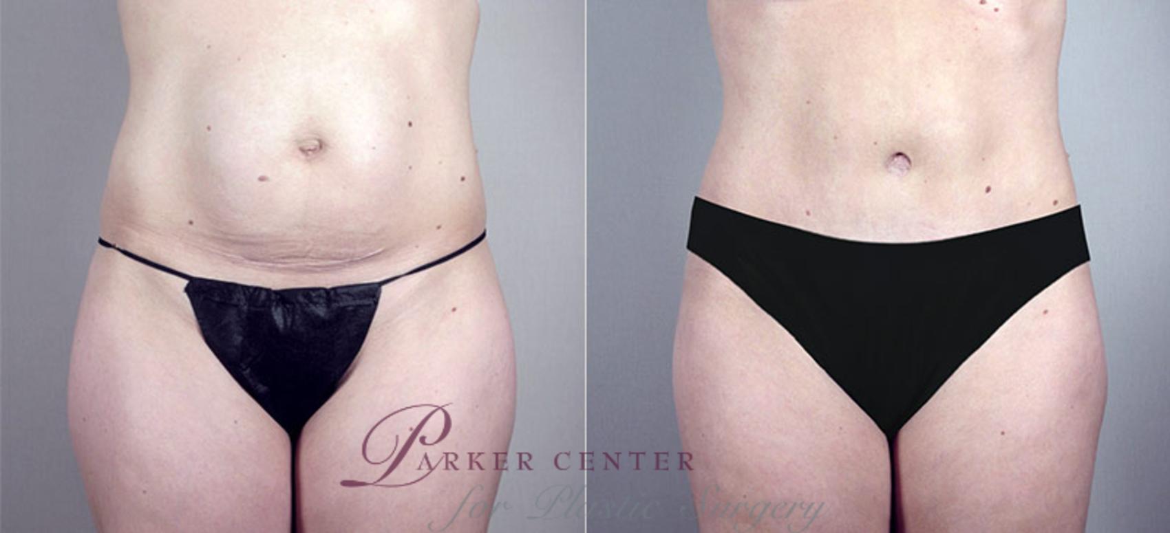 Mommy Makeover Case 381 Before & After View #3 | Paramus, NJ | Parker Center for Plastic Surgery