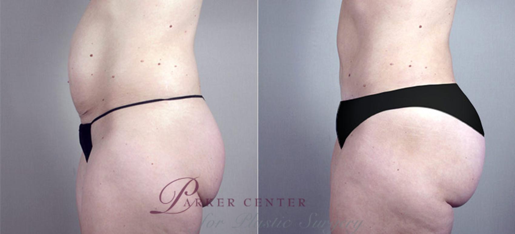 Mommy Makeover Case 381 Before & After View #4 | Paramus, NJ | Parker Center for Plastic Surgery