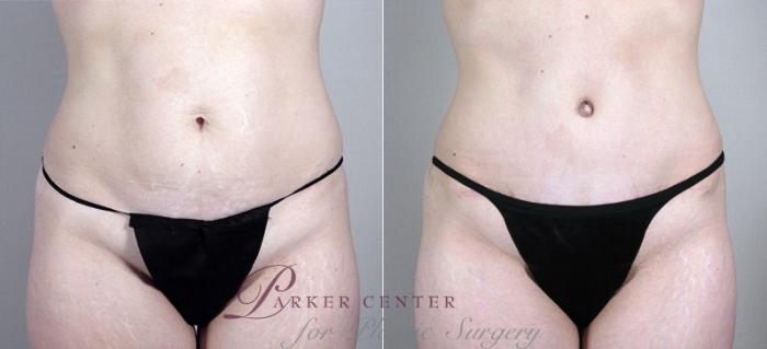 Mommy Makeover Case 383 Before & After View #3 | Paramus, NJ | Parker Center for Plastic Surgery